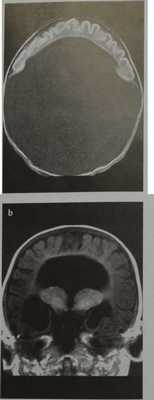 Снимки МРТ и КТ. Голопрозэнцефалия