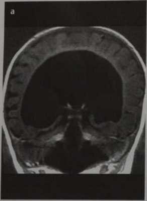Снимки МРТ и КТ. Голопрозэнцефалия