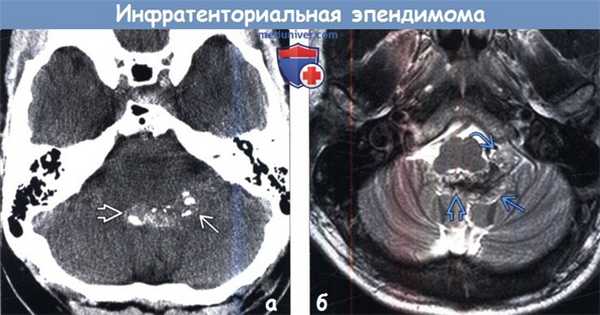 Инфратенториальная эпендимома на КТ, МРТ