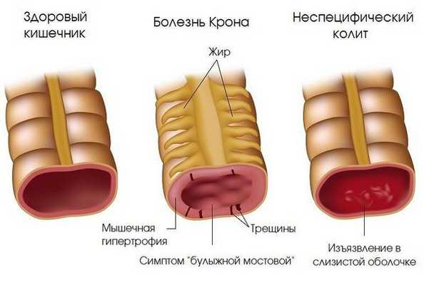 Болезнь Крона