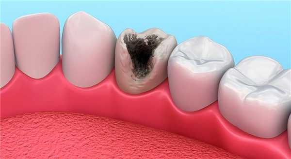 очаги поражения кариесом