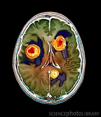 КТ опухолей