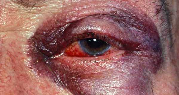 Ушиб (контузия) глазного яблока