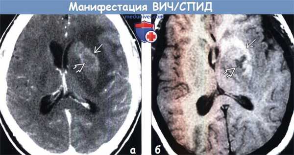 Манифестация ВИЧ/СПИД на КТ, МРТ головного мозга