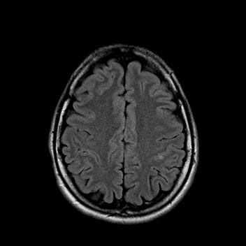 Инфаркт головного мозга (лакунарный инфаркт)
