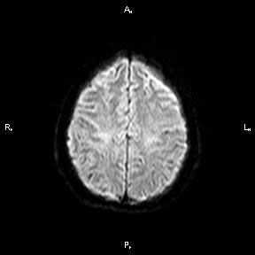 Инфаркт головного мозга (лакунарный инфаркт)