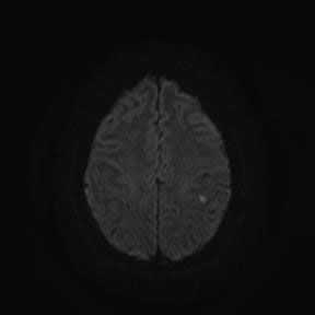 Инфаркт головного мозга (лакунарный инфаркт)