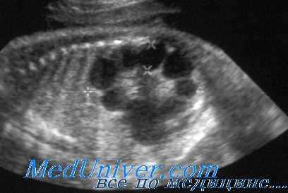 Поликистоз почек