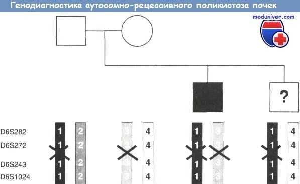 Генодиагностика аутосомно-рецессивного поликистоза почек