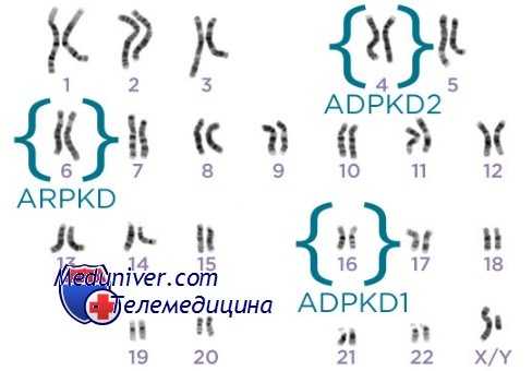 поликистоз почек