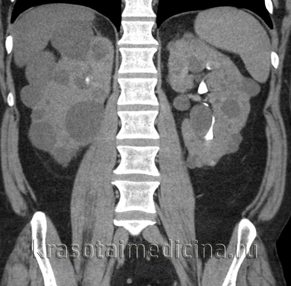 Поликистоз почек у детей