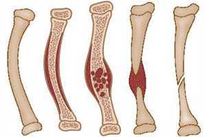Фиброзная дисплазия костей