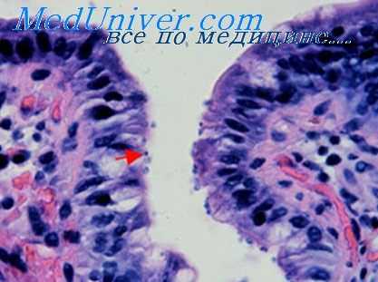 криптоспоридиоз