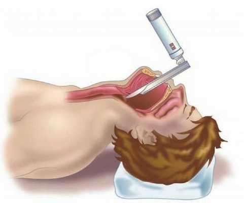 Жёсткая ларингоскопия