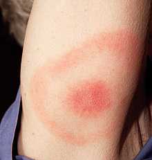 2007.James Gathany..This 2007 photograph depicts the pathognomonic erythematous rash in the pattern of a “bull’s-eye”, which manifested at the site of a tick bite on this Maryland woman’s posterior right upper arm, who’d subsequently contracted Lyme disease.Lyme disease patients who are diagnosed early, and receive proper antibiotic treatment, usually recover rapidly and completely. A key component of early diagnosis is recognition of the characteristic Lyme disease rash called erythema migrans. This rash often manifests itself in a “bull