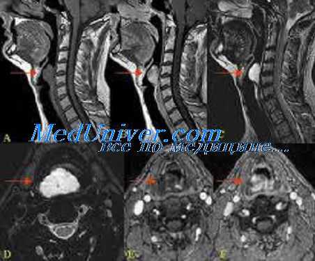 нарушения глотания