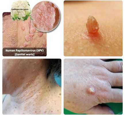 Варианты папиллом