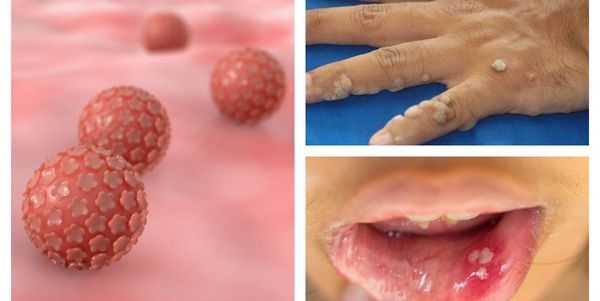 Поражение кожи и слизистой оболочки вирусом папилломы человека