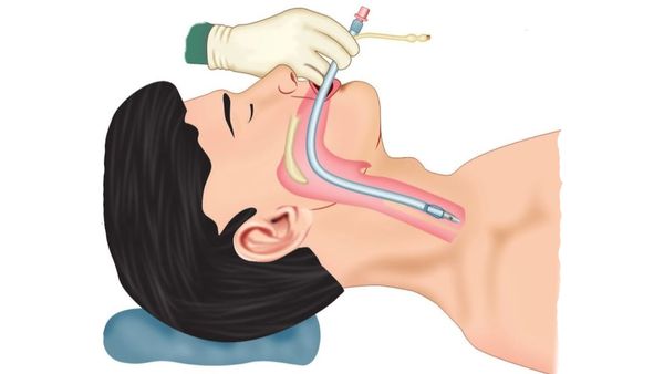 Интубация трахеи