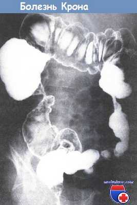 Болезнь Крона