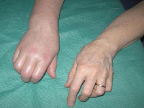 Синдром Зудека