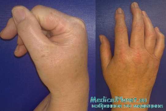 синдром Зудека