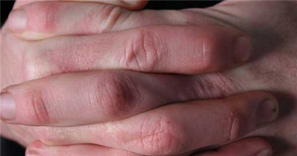 Симптомы слеродермии