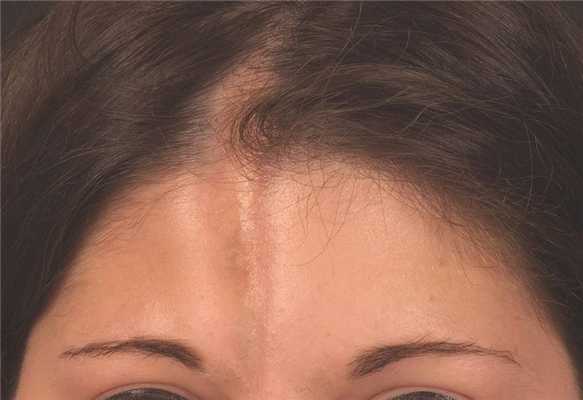 Системная склеродермия