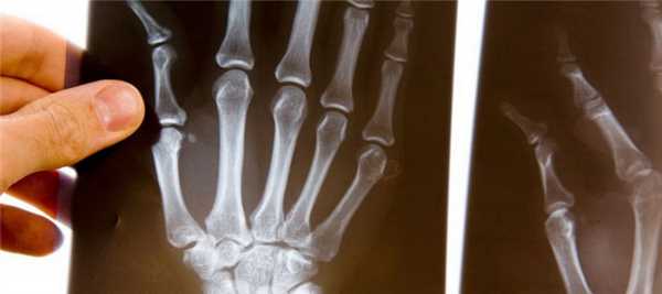 Склеродермия