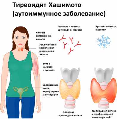 Хашимото.jpg