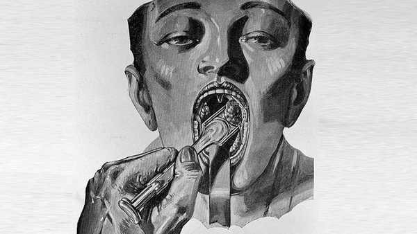 Тонзиллэктомия - как проходит удаление миндалин?