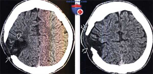 Лептоменингиальная киста на КТ
