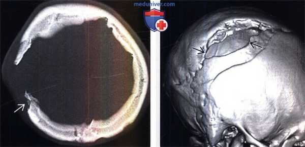 Лептоменингиальная киста на КТ