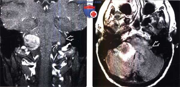 МРТ признаки метастазов мостомозжечкового угла и внутреннего слухового прохода (ММУ-ВСП)