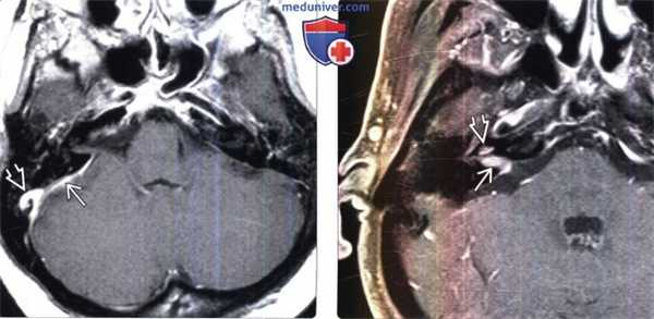 МРТ признаки метастазов мостомозжечкового угла и внутреннего слухового прохода (ММУ-ВСП)