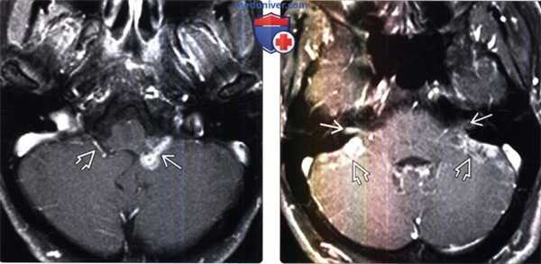 МРТ признаки метастазов мостомозжечкового угла и внутреннего слухового прохода (ММУ-ВСП)
