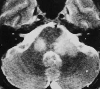 лимфолейкоз