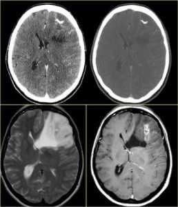 глиобластома