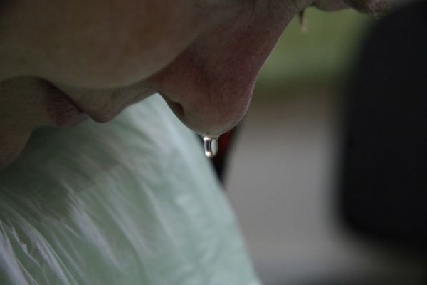 Назальная ликворея