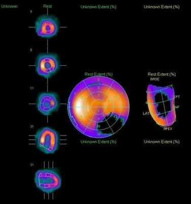 сцинтиграфия миокарда в покое