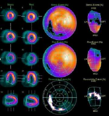 перфузионная сцинтиграфия в покое