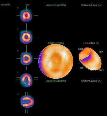 сцинтиграмма миокарда