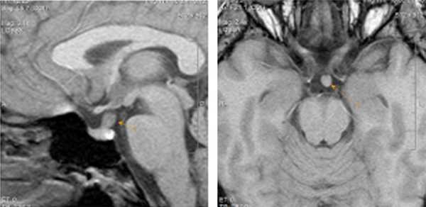 Лимфоцитарный гипофизит: клинический случай