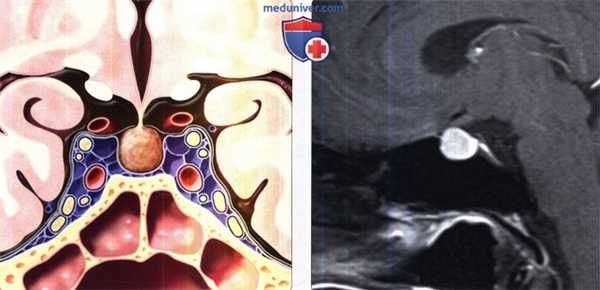 Гиперплазия гипофиза на МРТ головного мозга