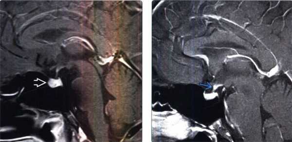 Лимфоцитарный гипофизит на МРТ головного мозга