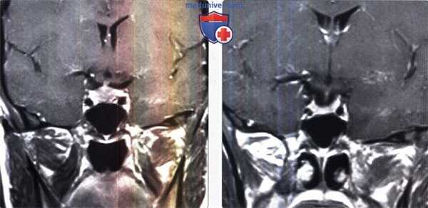 Гиперплазия гипофиза на МРТ головного мозга