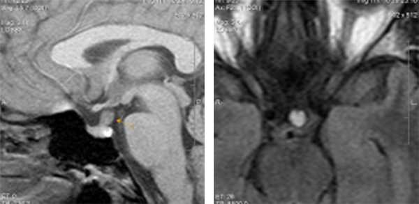 Лимфоцитарный гипофизит: клинический случай