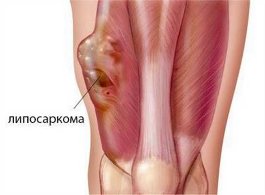 Липосаркома