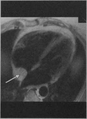 Снимки МРТ и КТ. Липома