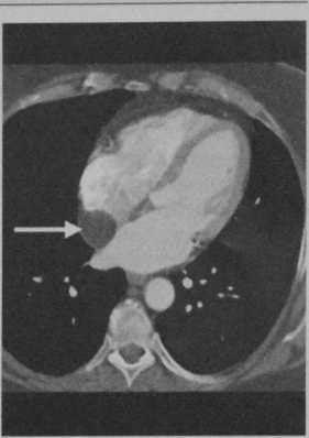 Снимки МРТ и КТ. Липома